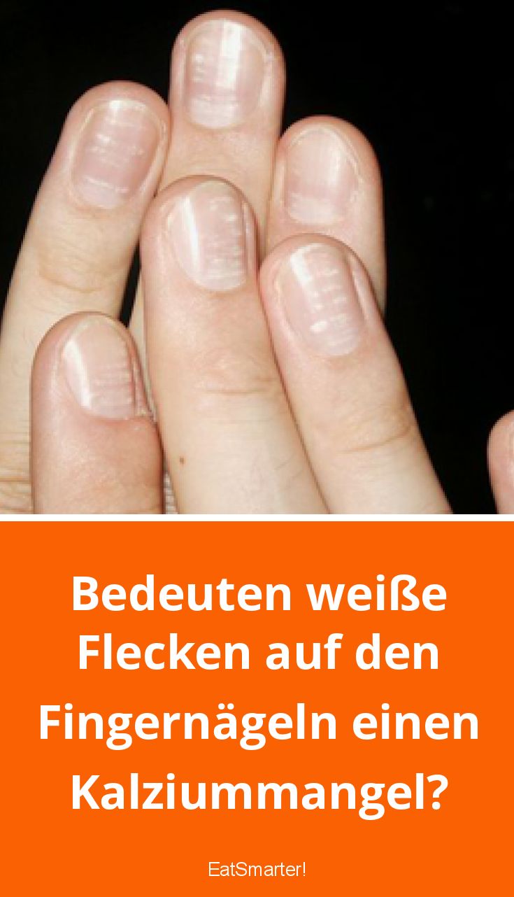 Bedeuten weiße Flecken auf den Fingernägeln einen Kalziummangel? | EAT