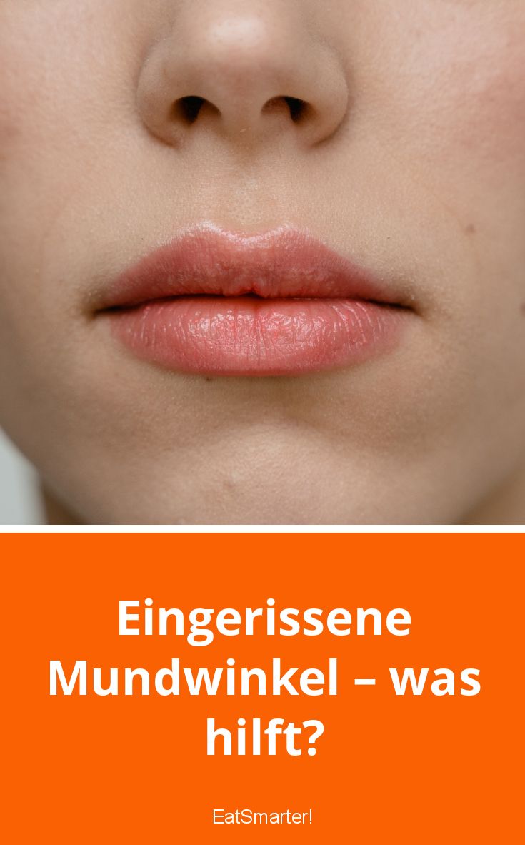 Eingerissene Mundwinkel? Das hilft! | EAT SMARTER